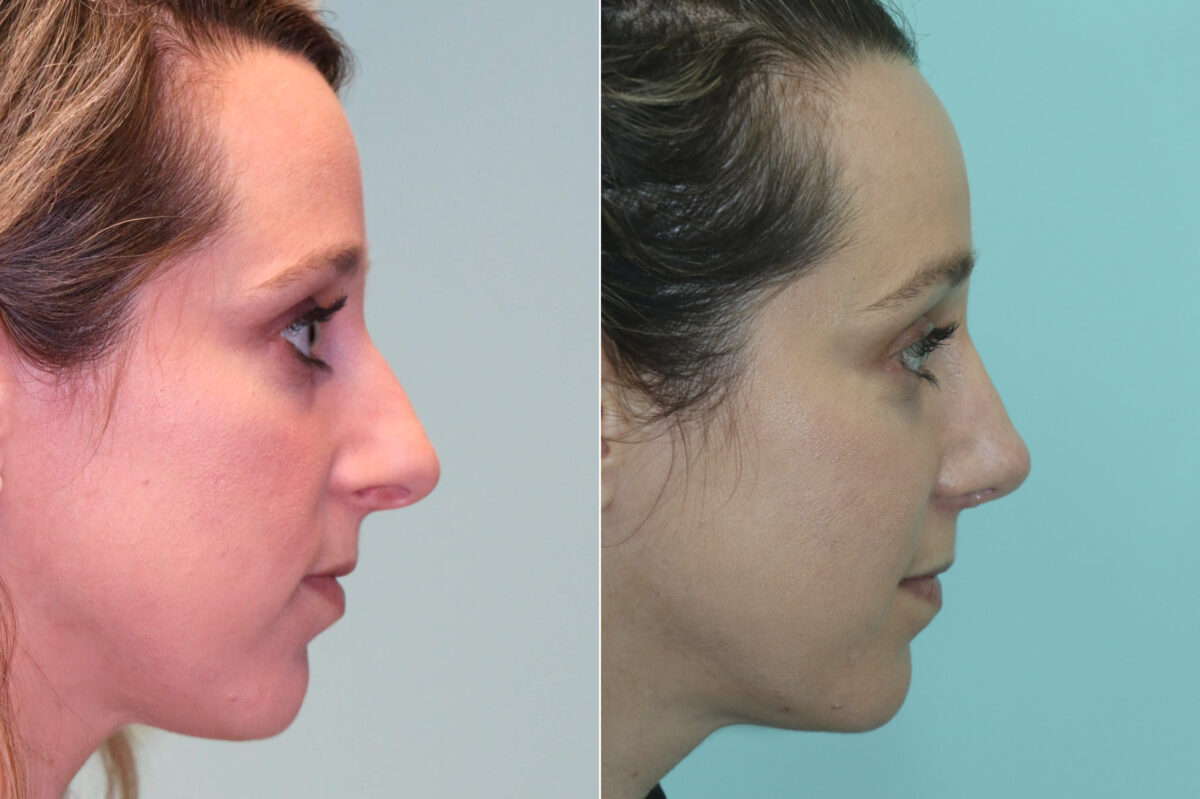 Rhinoplasty before and after at The Naderi Center, Reston, VA and Chevy Chase, MD, Patient 19032