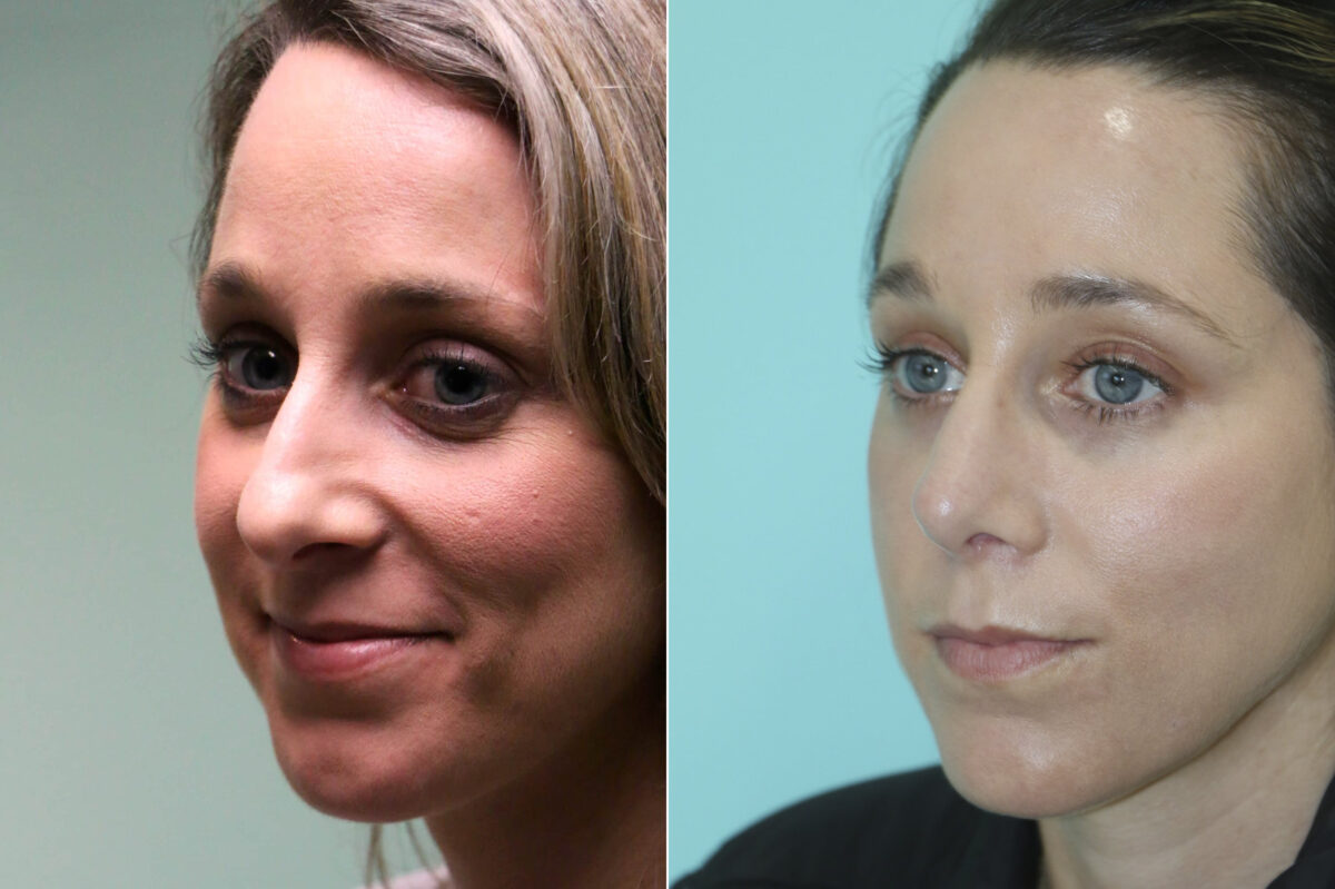 Rhinoplasty before and after at The Naderi Center, Reston, VA and Chevy Chase, MD, Patient 19032