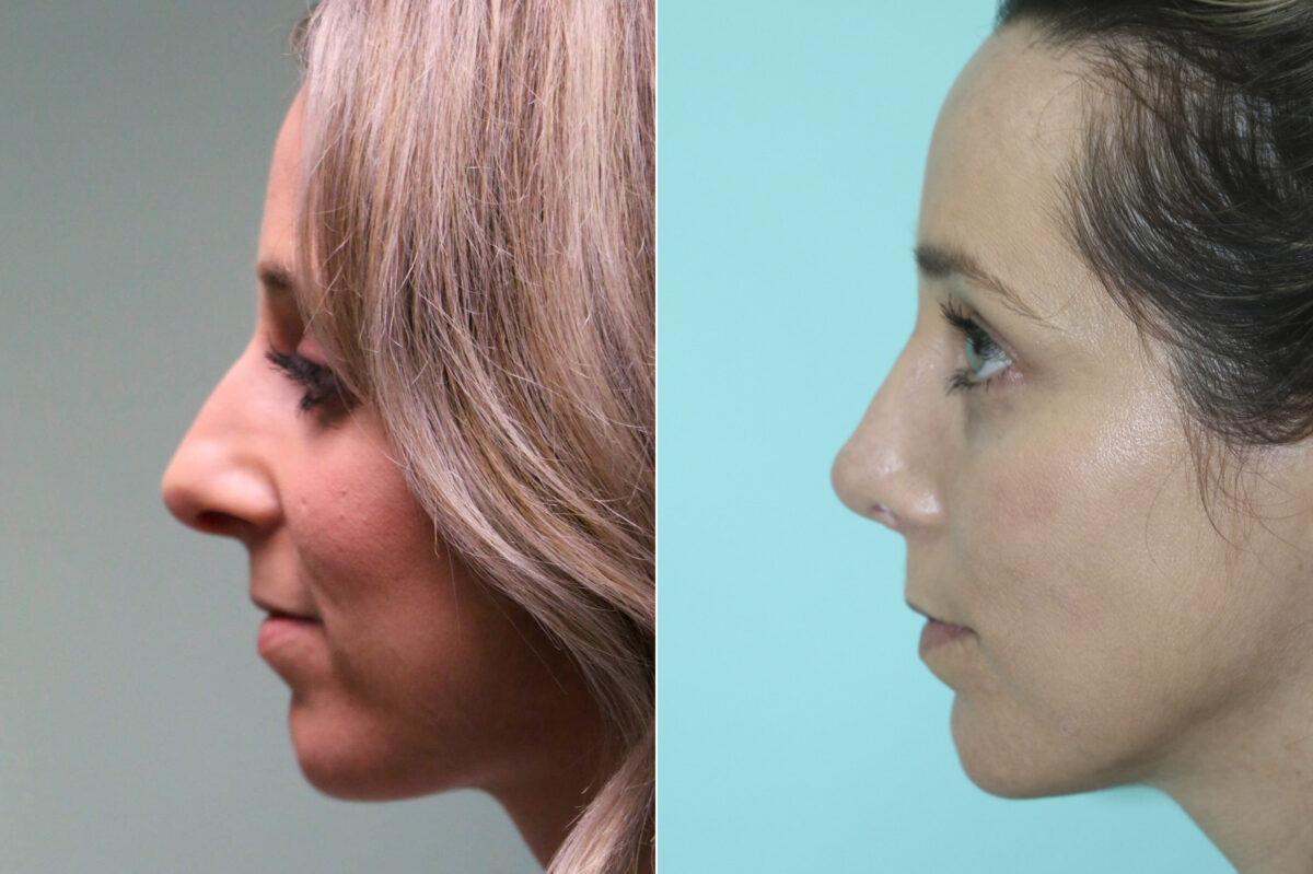 Rhinoplasty before and after at The Naderi Center, Reston, VA and Chevy Chase, MD, Patient 19032