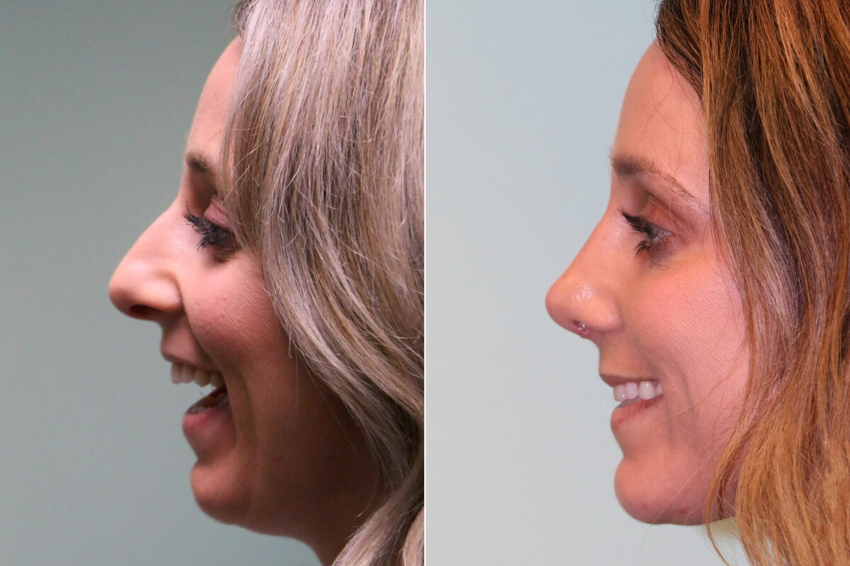 Rhinoplasty before and after at The Naderi Center, Reston, VA and Chevy Chase, MD, Patient 19032