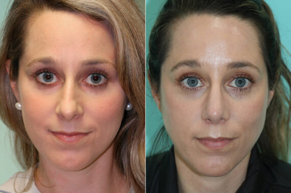 Rhinoplasty before and after at The Naderi Center, Reston, VA and Chevy Chase, MD, Patient 19032