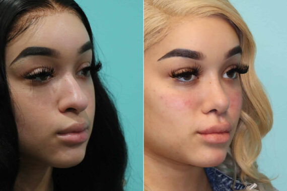 Cheeks / Midface Injections before and after at The Naderi Center, Reston, VA and Chevy Chase, MD, Patient 19620