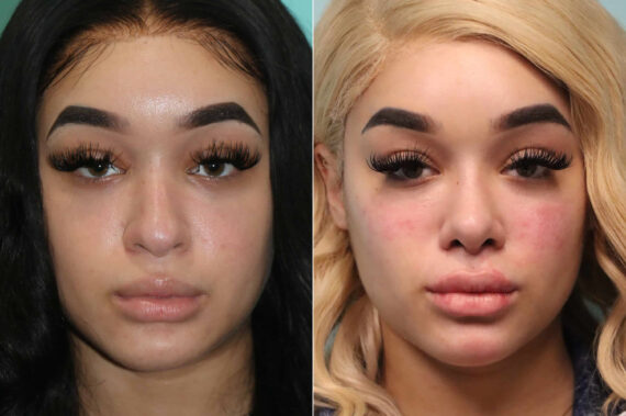 Cheeks / Midface Injections before and after at The Naderi Center, Reston, VA and Chevy Chase, MD, Patient 19620