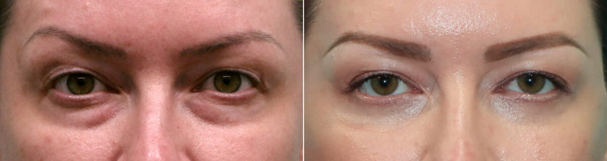 Blepharoplasty before and after, Patient 19942