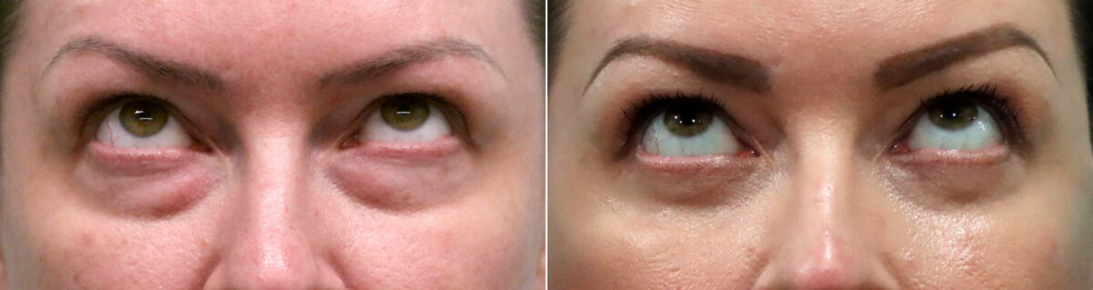 Blepharoplasty before and after, Patient 19942