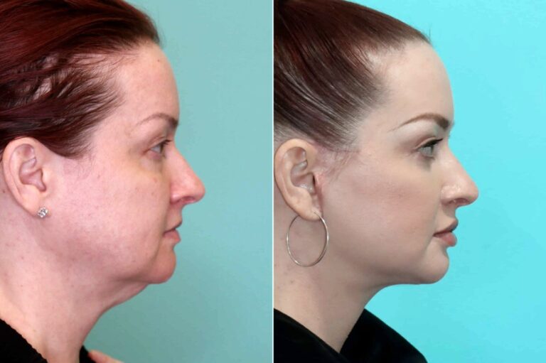 Before and after facelift, side profile: laxity around the jowls and neck