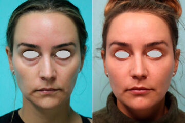 Blepharoplasty before and after at The Naderi Center, Reston, VA and Chevy Chase, MD, Patient 21310