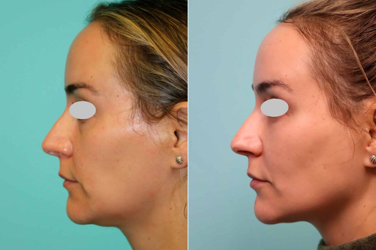 Blepharoplasty before and after at The Naderi Center, Reston, VA and Chevy Chase, MD, Patient 21310