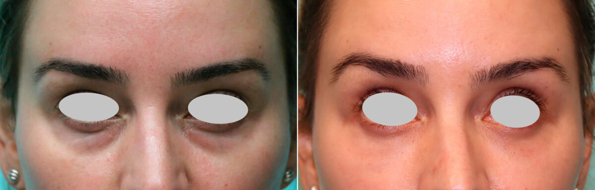Blepharoplasty before and after at The Naderi Center, Reston, VA and Chevy Chase, MD, Patient 21310