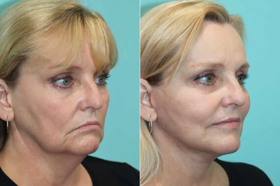 Facelift before and after at The Naderi Center, Reston, VA and Chevy Chase, MD, Patient 21366