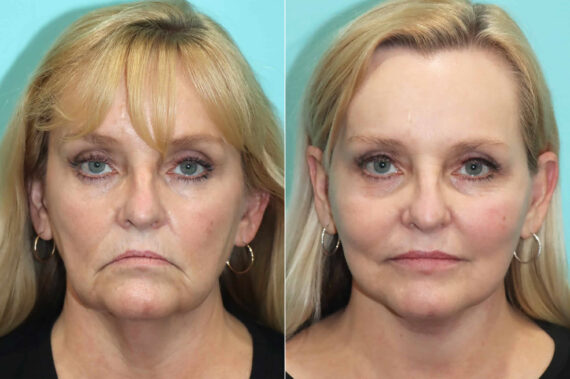 Facelift before and after at The Naderi Center, Reston, VA and Chevy Chase, MD, Patient 21366
