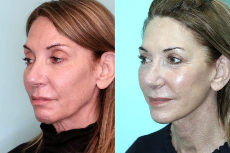 Before and after facelift, angled view: a smoother jawline at three months