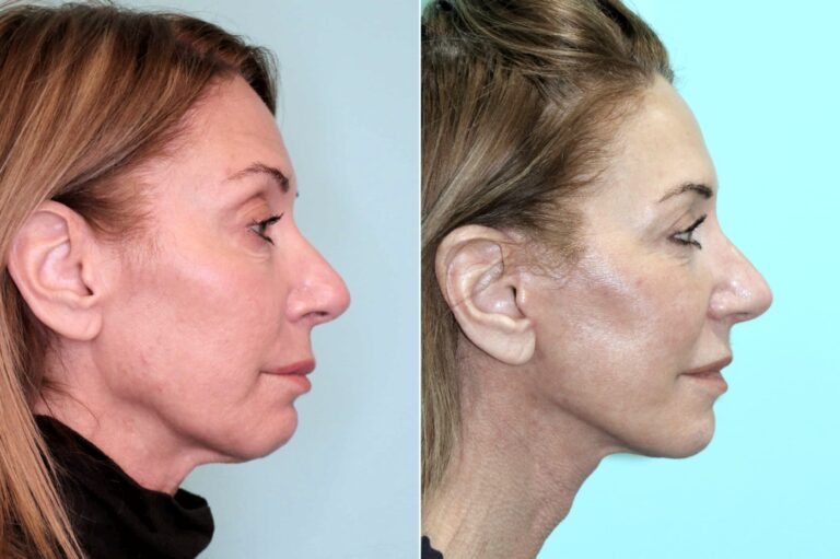 Before and after facelift and neck lift, side profile