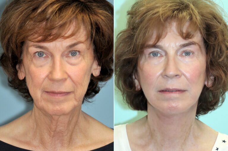 Before and after facelift: tighter, and still natural