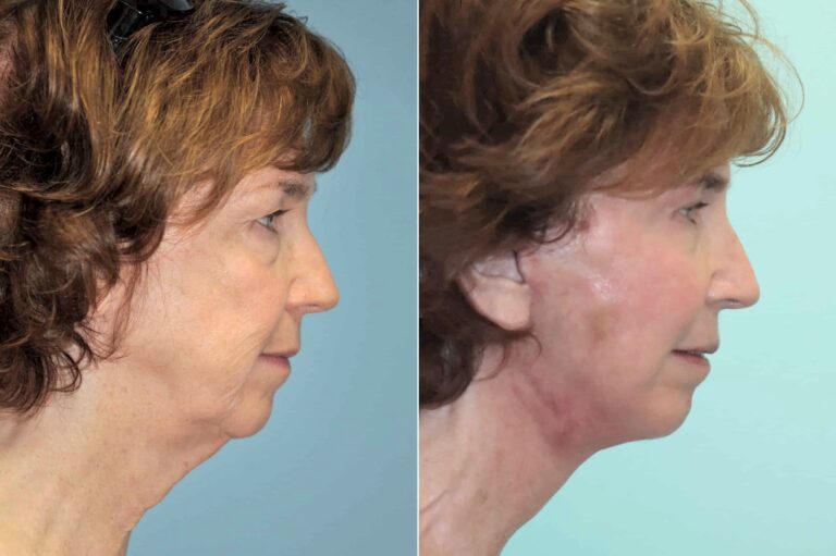 Before and after facelift and neck lift, side profile: a tighter neck that still looks natural