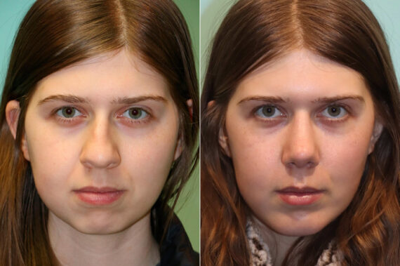Chin & Facial Implant before and after at The Naderi Center, Reston, VA and Chevy Chase, MD, Patient 23073