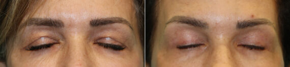 Blepharoplasty before and after at The Naderi Center, Reston, VA and Chevy Chase, MD, Patient 23154