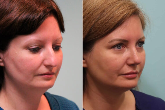 Lip Augmentation before and after at The Naderi Center, Reston, VA and Chevy Chase, MD, Patient 23161