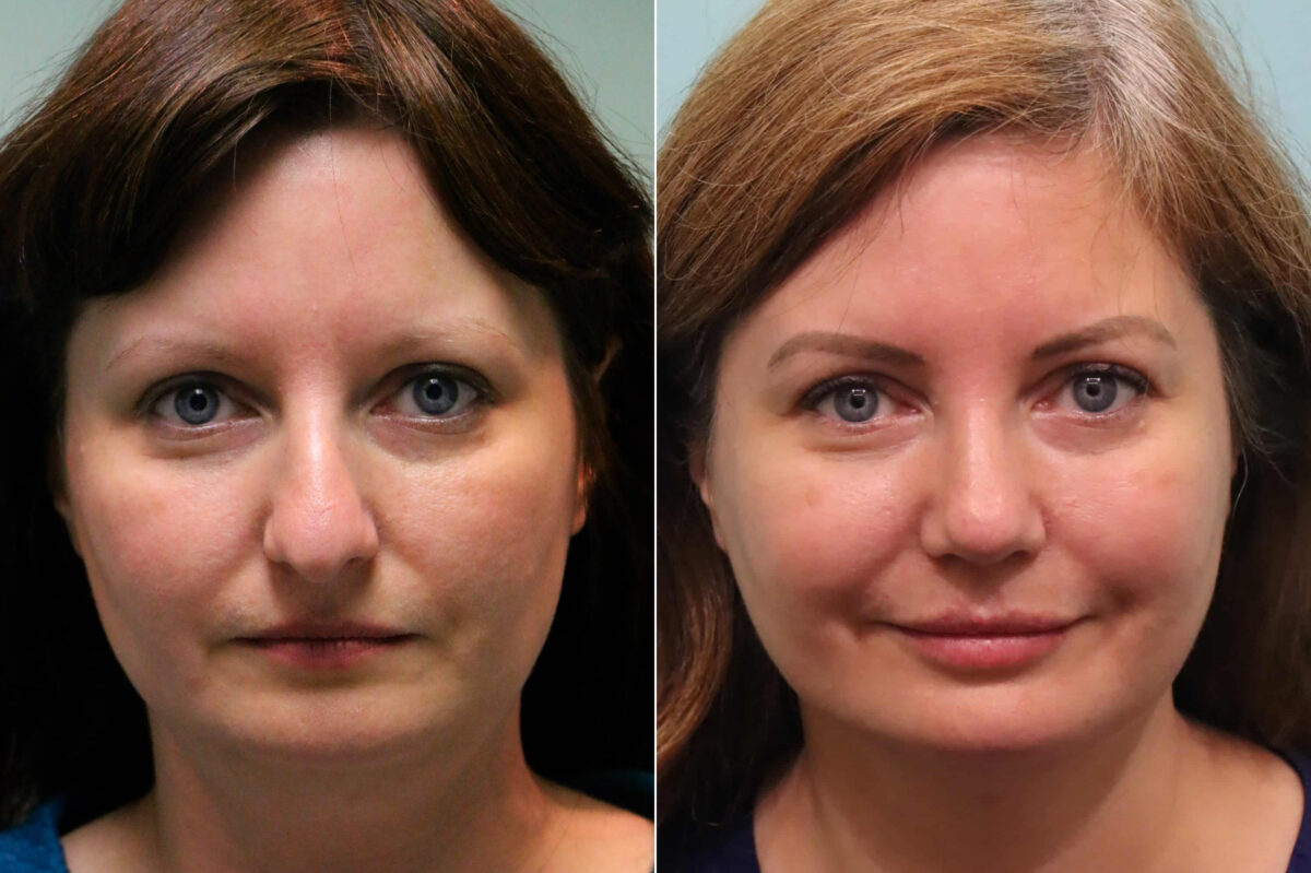 Lip Augmentation before and after at The Naderi Center, Reston, VA and Chevy Chase, MD, Patient 23161
