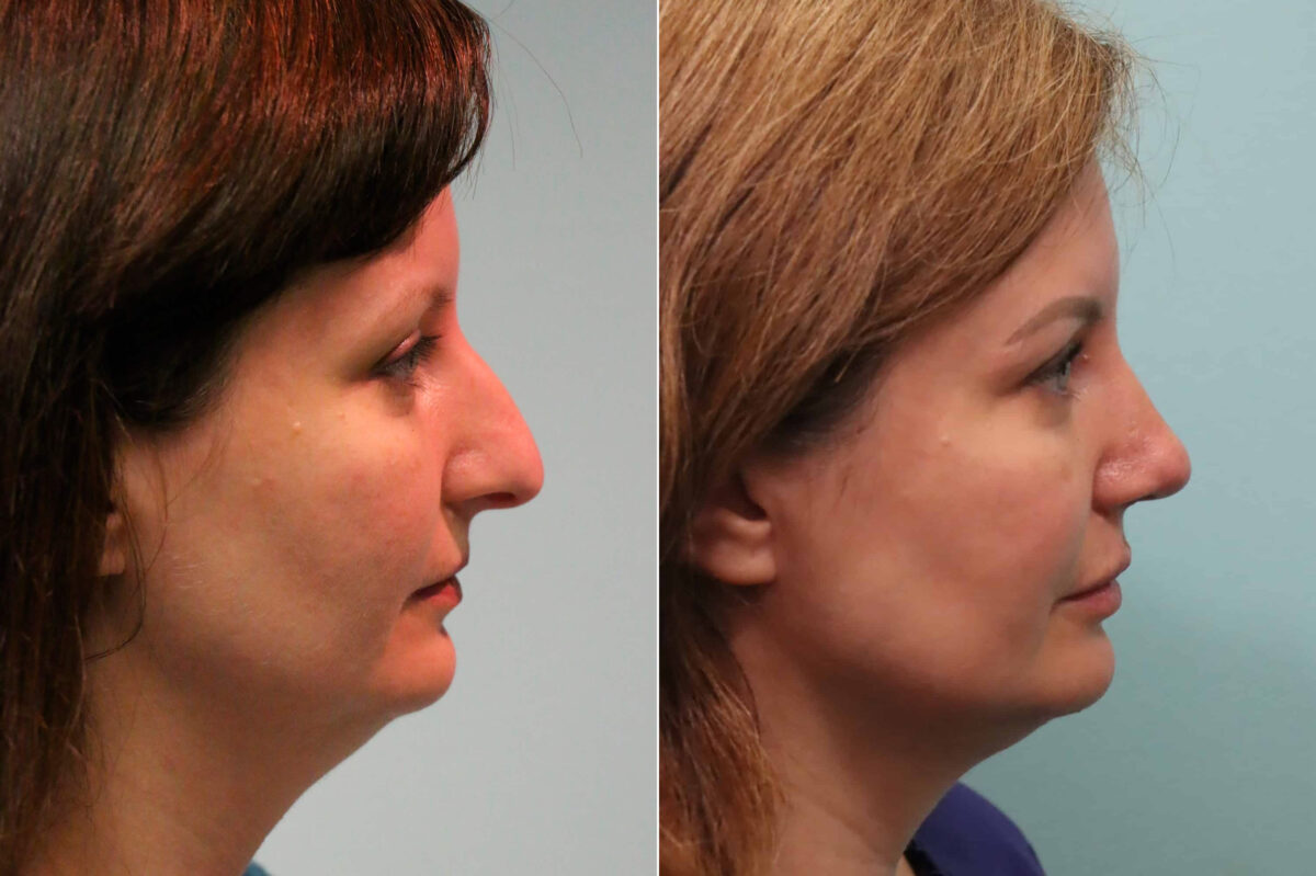 Lip Augmentation before and after at The Naderi Center, Reston, VA and Chevy Chase, MD, Patient 23161