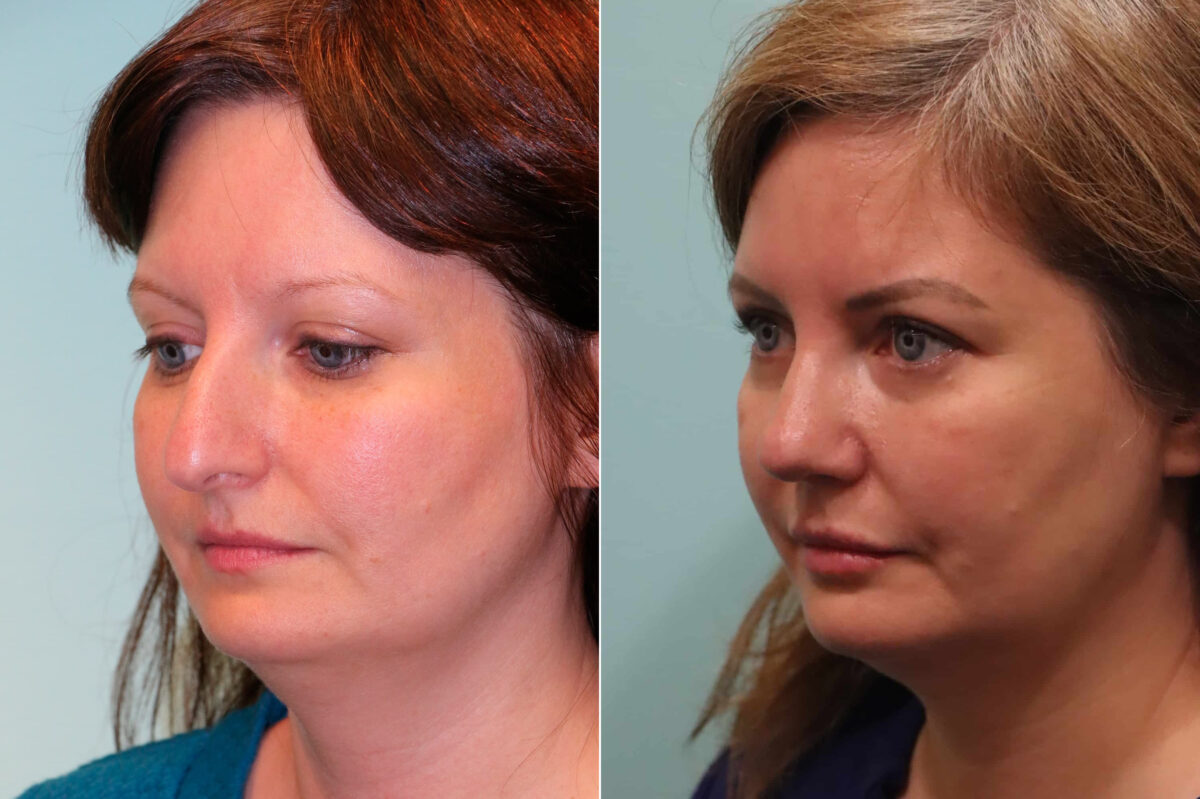 Lip Augmentation before and after at The Naderi Center, Reston, VA and Chevy Chase, MD, Patient 23161