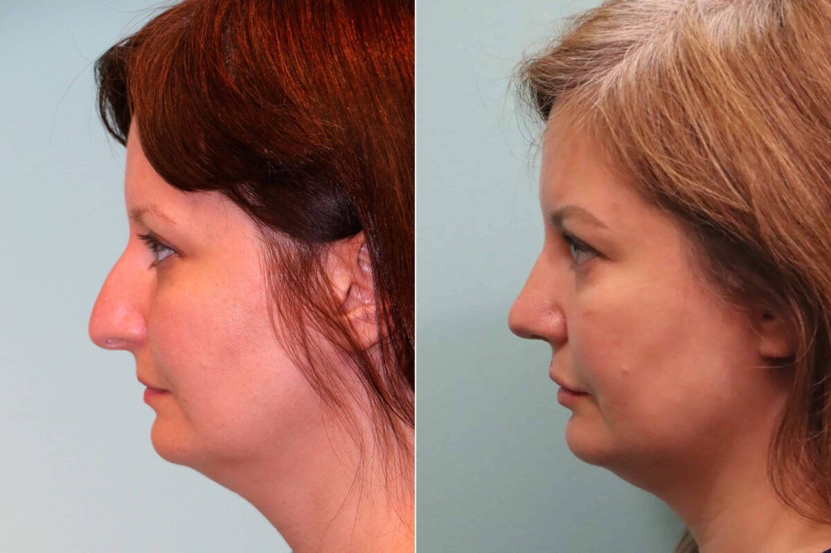 Lip Augmentation before and after at The Naderi Center, Reston, VA and Chevy Chase, MD, Patient 23161