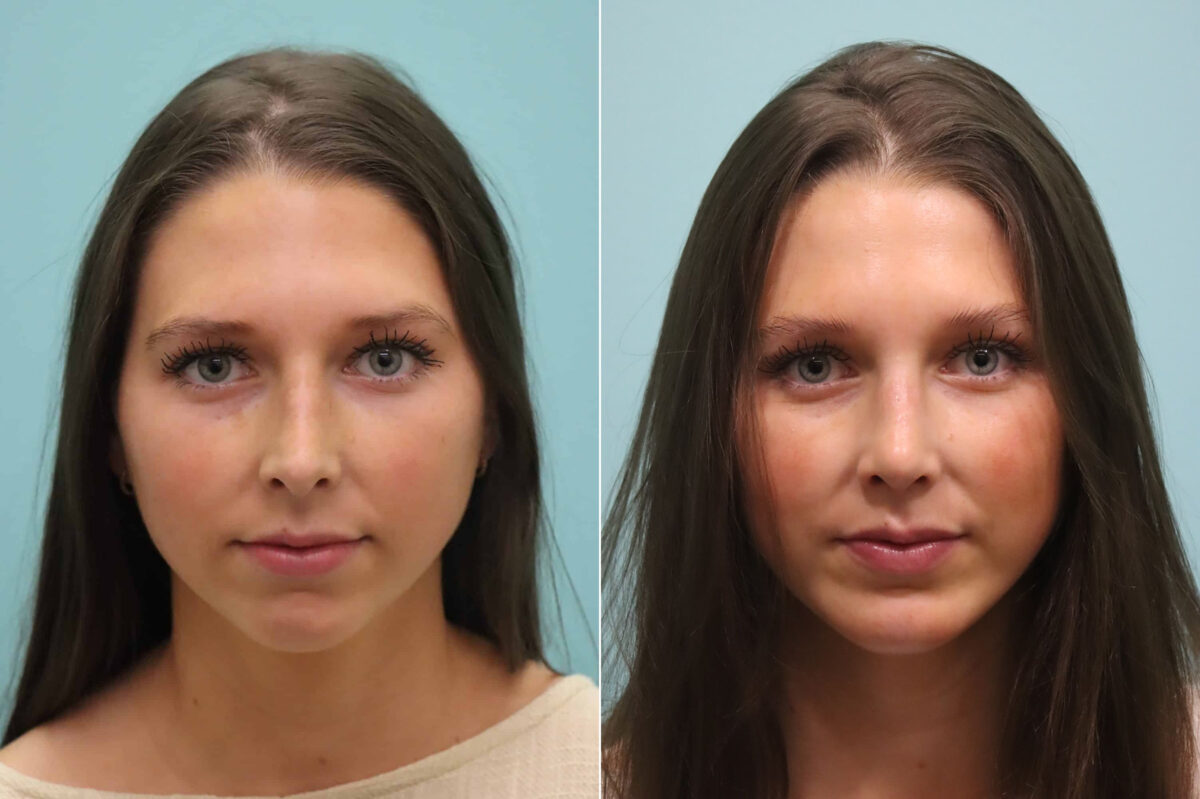 Rhinoplasty before and after at The Naderi Center, Reston, VA and Chevy Chase, MD, Patient 23374