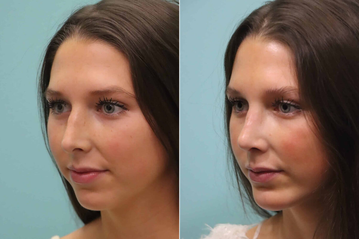 Rhinoplasty before and after at The Naderi Center, Reston, VA and Chevy Chase, MD, Patient 23374