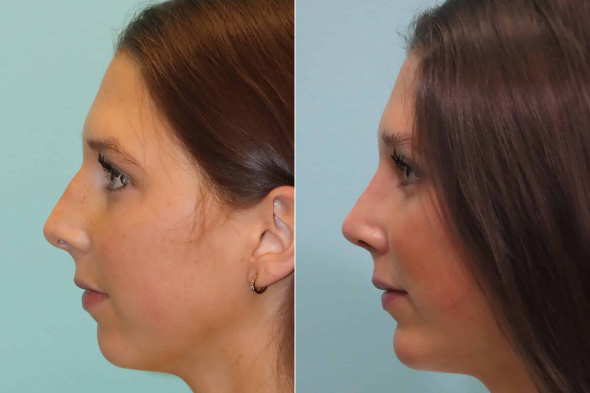 Rhinoplasty before and after at The Naderi Center, Reston, VA and Chevy Chase, MD, Patient 23374