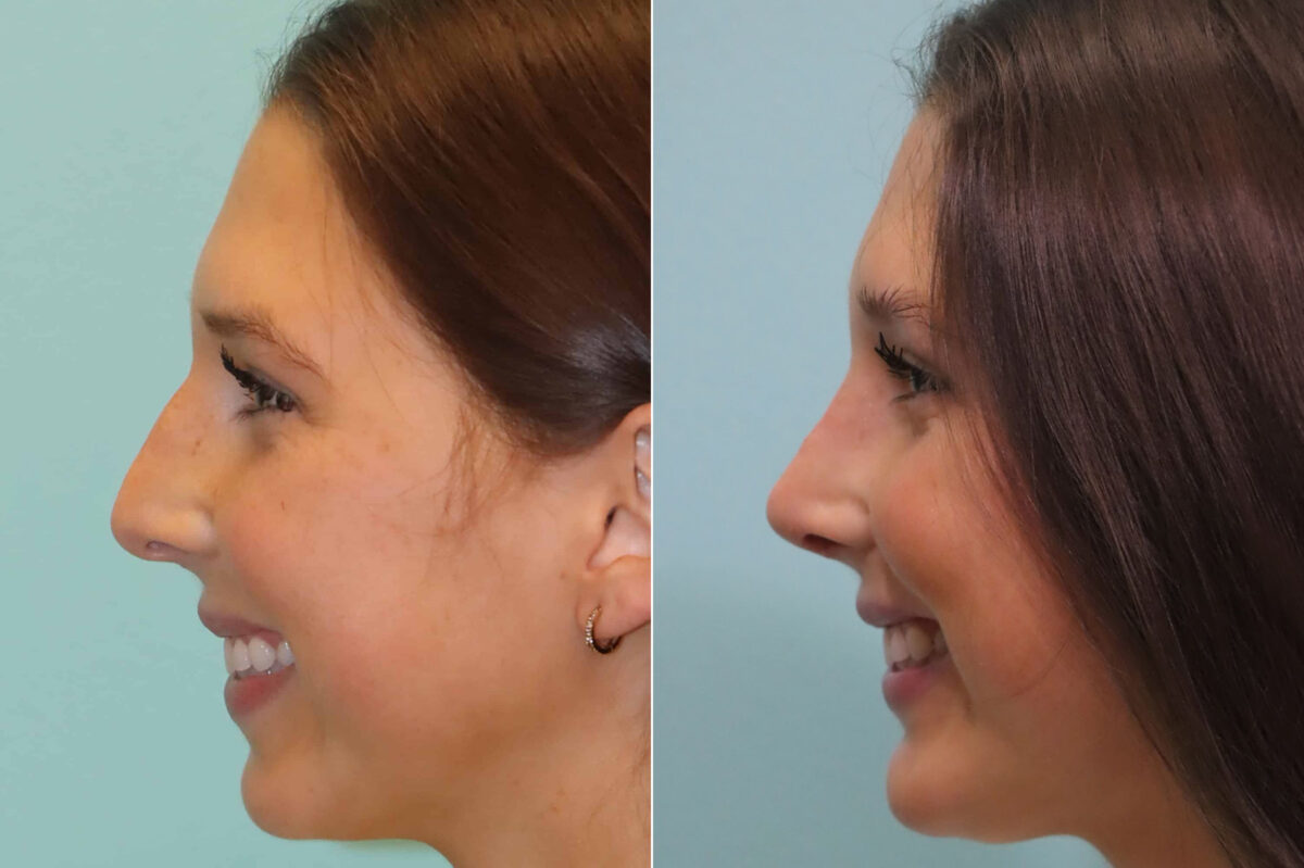 Rhinoplasty before and after at The Naderi Center, Reston, VA and Chevy Chase, MD, Patient 23374