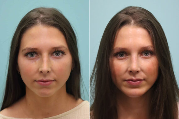 Rhinoplasty before and after at The Naderi Center, Reston, VA and Chevy Chase, MD, Patient 23374