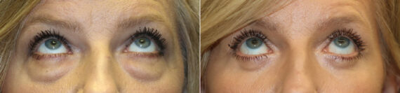 Blepharoplasty before and after at The Naderi Center, Reston, VA and Chevy Chase, MD, Patient 23428