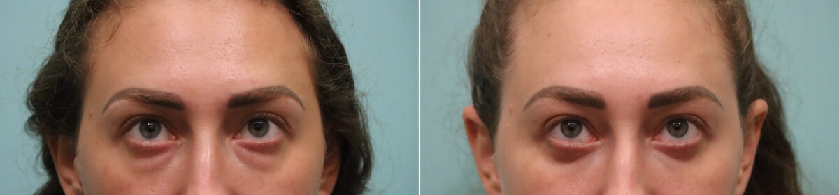 Blepharoplasty before and after at The Naderi Center, Reston, VA and Chevy Chase, MD, Patient 23655