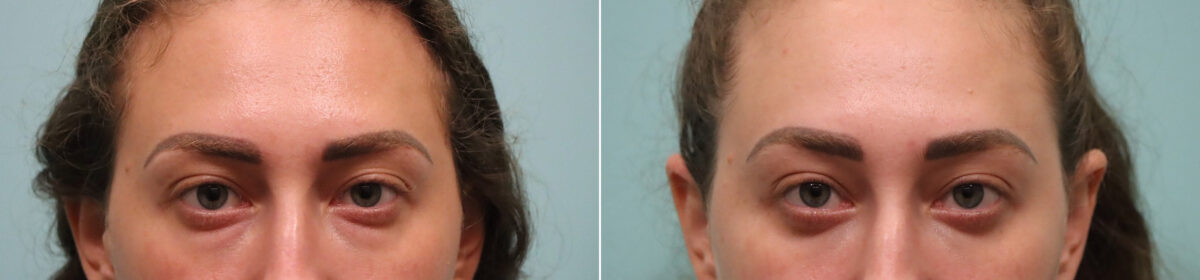 Blepharoplasty before and after at The Naderi Center, Reston, VA and Chevy Chase, MD, Patient 23655