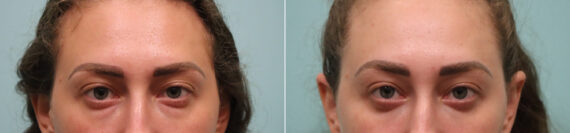 Blepharoplasty before and after at The Naderi Center, Reston, VA and Chevy Chase, MD, Patient 23655