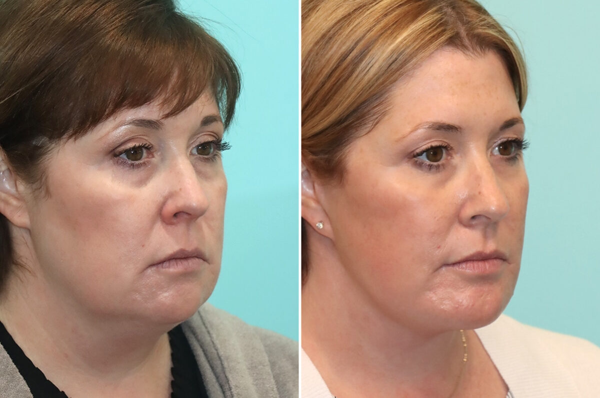 Chin & Facial Implant before and after at The Naderi Center, Reston, VA and Chevy Chase, MD, Patient 24496