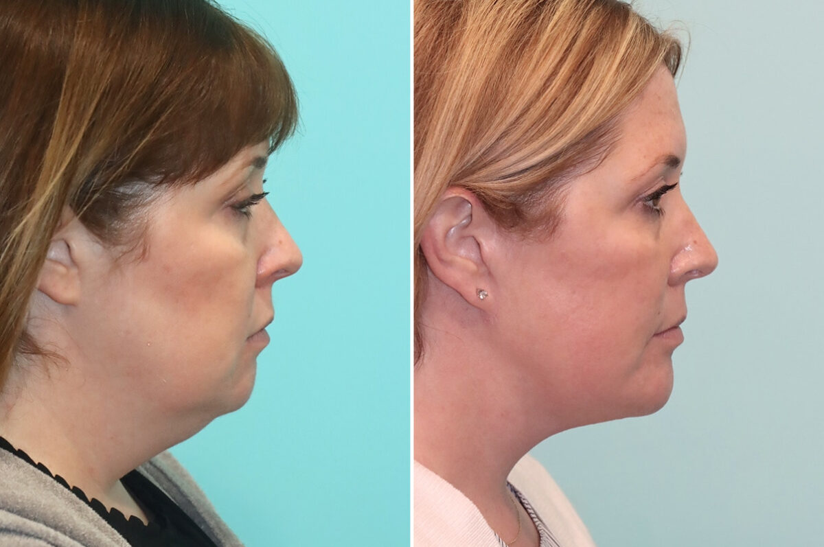 Chin & Facial Implant before and after at The Naderi Center, Reston, VA and Chevy Chase, MD, Patient 24496