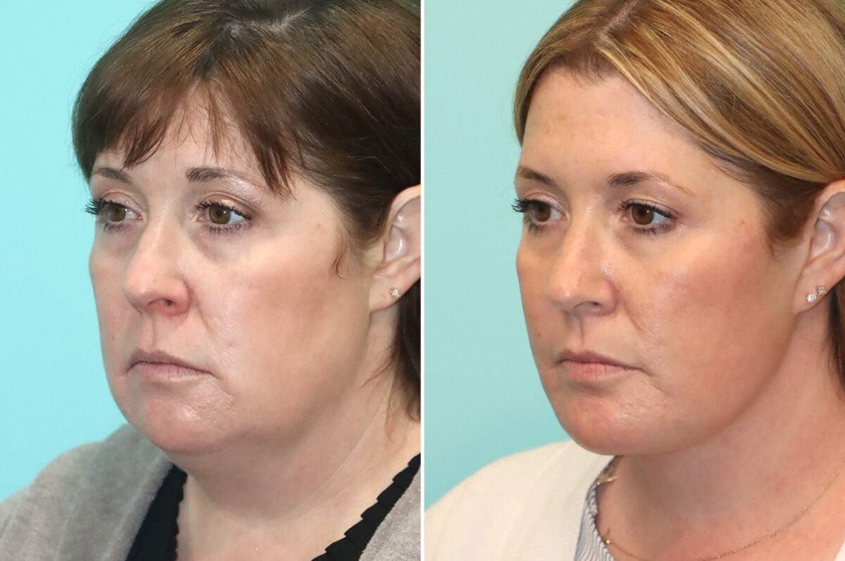 Chin & Facial Implant before and after at The Naderi Center, Reston, VA and Chevy Chase, MD, Patient 24496