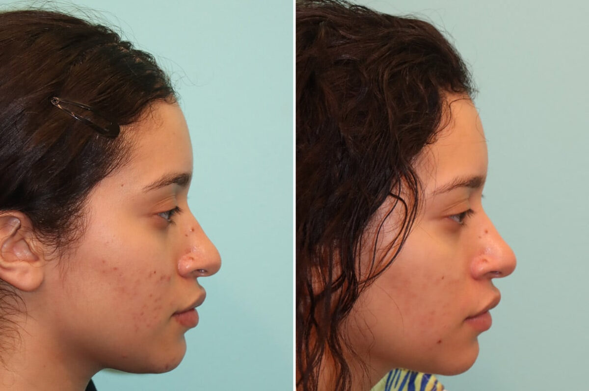 Light Therapy before and after, Patient 25059
