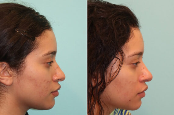 Light Therapy before and after, Patient 25059