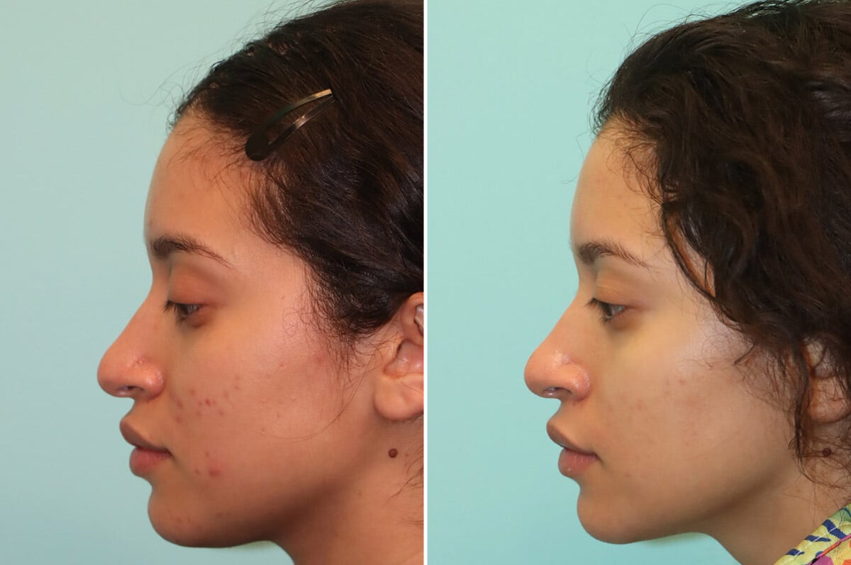 Light Therapy before and after, Patient 25059