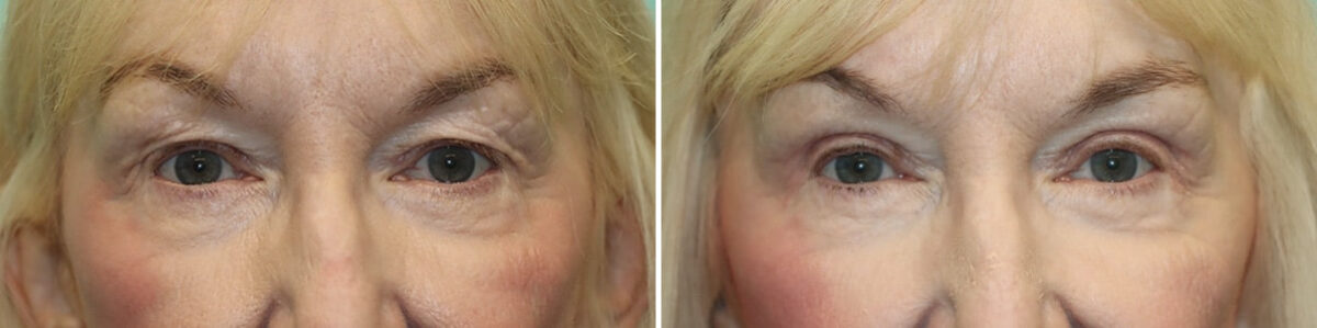 Blepharoplasty before and after at The Naderi Center, Reston, VA and Chevy Chase, MD, Patient 25661
