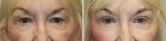Blepharoplasty before and after at The Naderi Center, Reston, VA and Chevy Chase, MD, Patient 25661