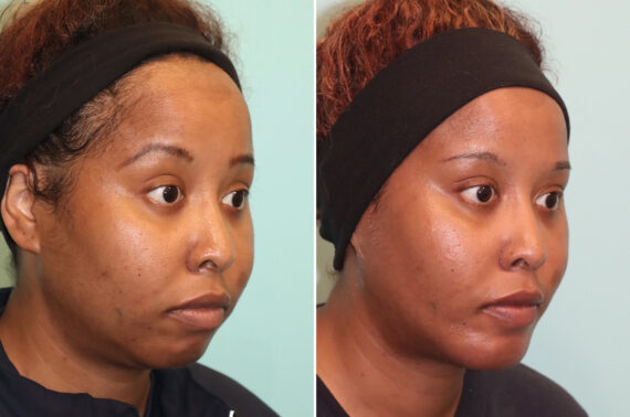 Neck Liposuction before and after at The Naderi Center, Reston, VA and Chevy Chase, MD, Patient 25731