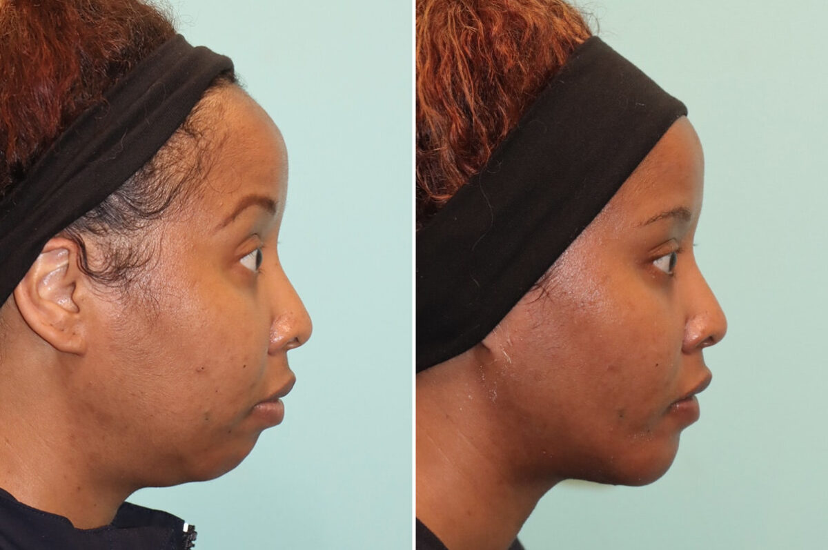 Neck Liposuction before and after at The Naderi Center, Reston, VA and Chevy Chase, MD, Patient 25731