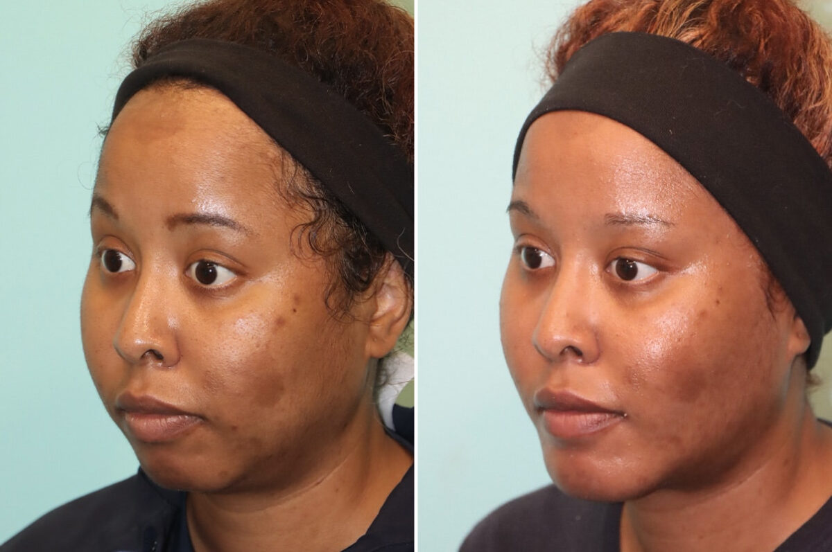 Neck Liposuction before and after at The Naderi Center, Reston, VA and Chevy Chase, MD, Patient 25731
