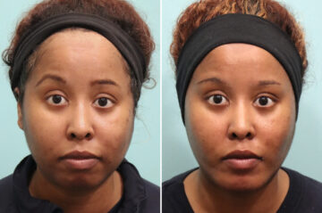 Neck Liposuction before and after at The Naderi Center, Reston, VA and Chevy Chase, MD, Patient 25731