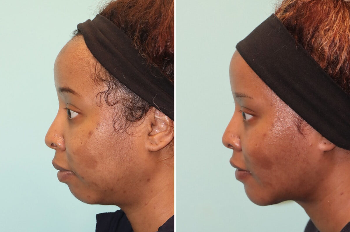 Neck Liposuction before and after at The Naderi Center, Reston, VA and Chevy Chase, MD, Patient 25731