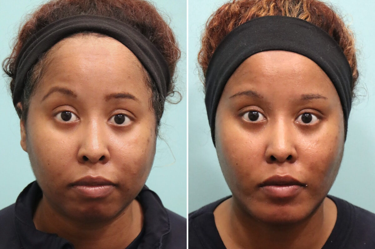 Chin & Facial Implant before and after at The Naderi Center, Reston, VA and Chevy Chase, MD, Patient 25738