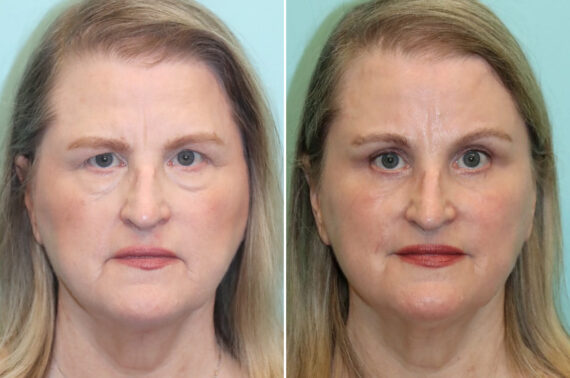 Blepharoplasty before and after at The Naderi Center, Reston, VA and Chevy Chase, MD, Patient 25772